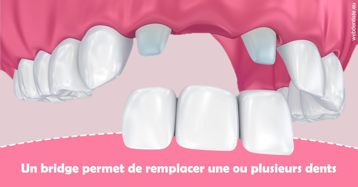 https://dr-reich-cyril.chirurgiens-dentistes.fr/Bridge remplacer dents 2