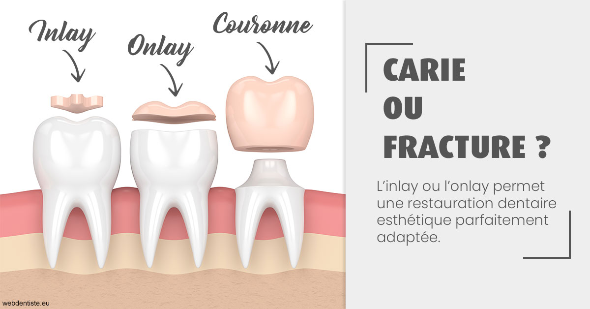 https://dr-reich-cyril.chirurgiens-dentistes.fr/T2 2023 - Carie ou fracture 1