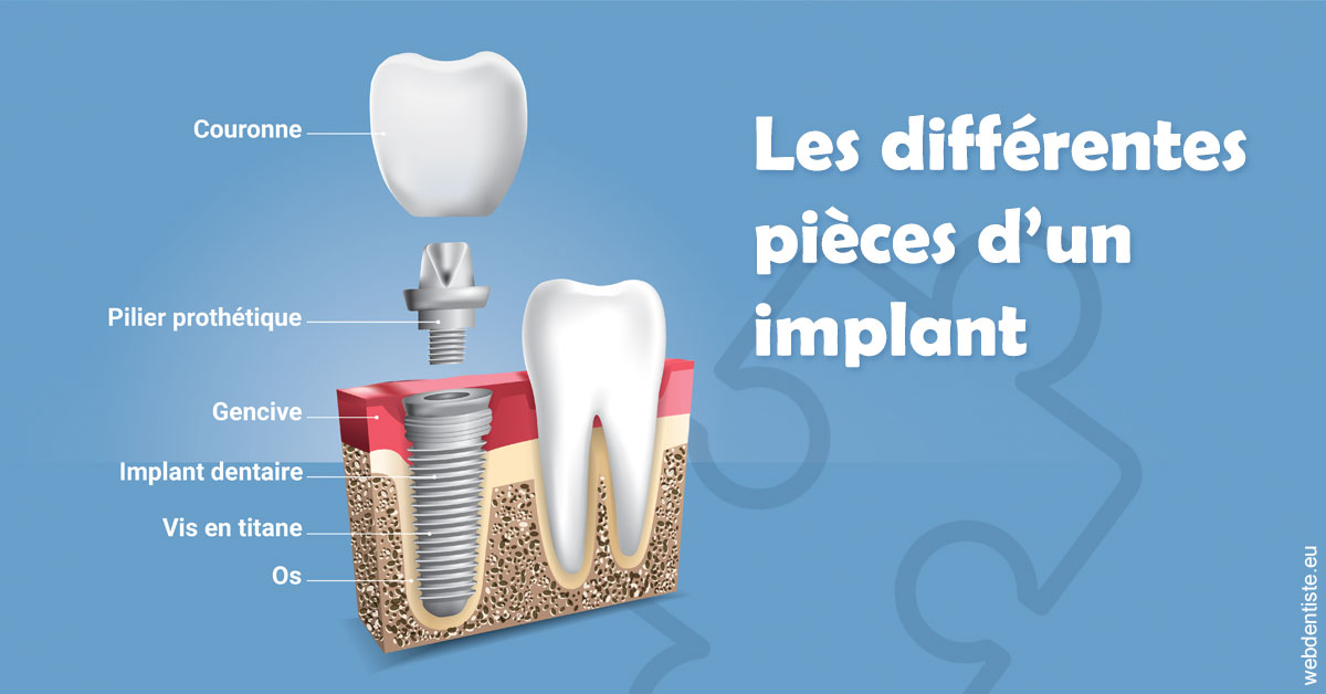 https://dr-reich-cyril.chirurgiens-dentistes.fr/Les différentes pièces d’un implant 1